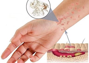 manifestations de la présence de parasites sous-cutanés chez l'homme
