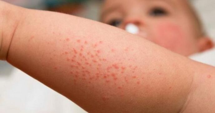 éruption cutanée comme symptôme d'une infection parasitaire